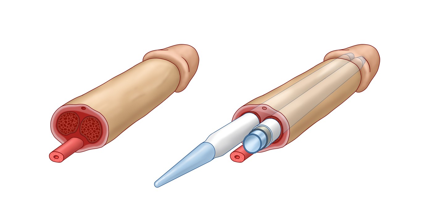 Medical illustration of an inflatable penile implant cylinder placed inside the penis, shown in cross-section