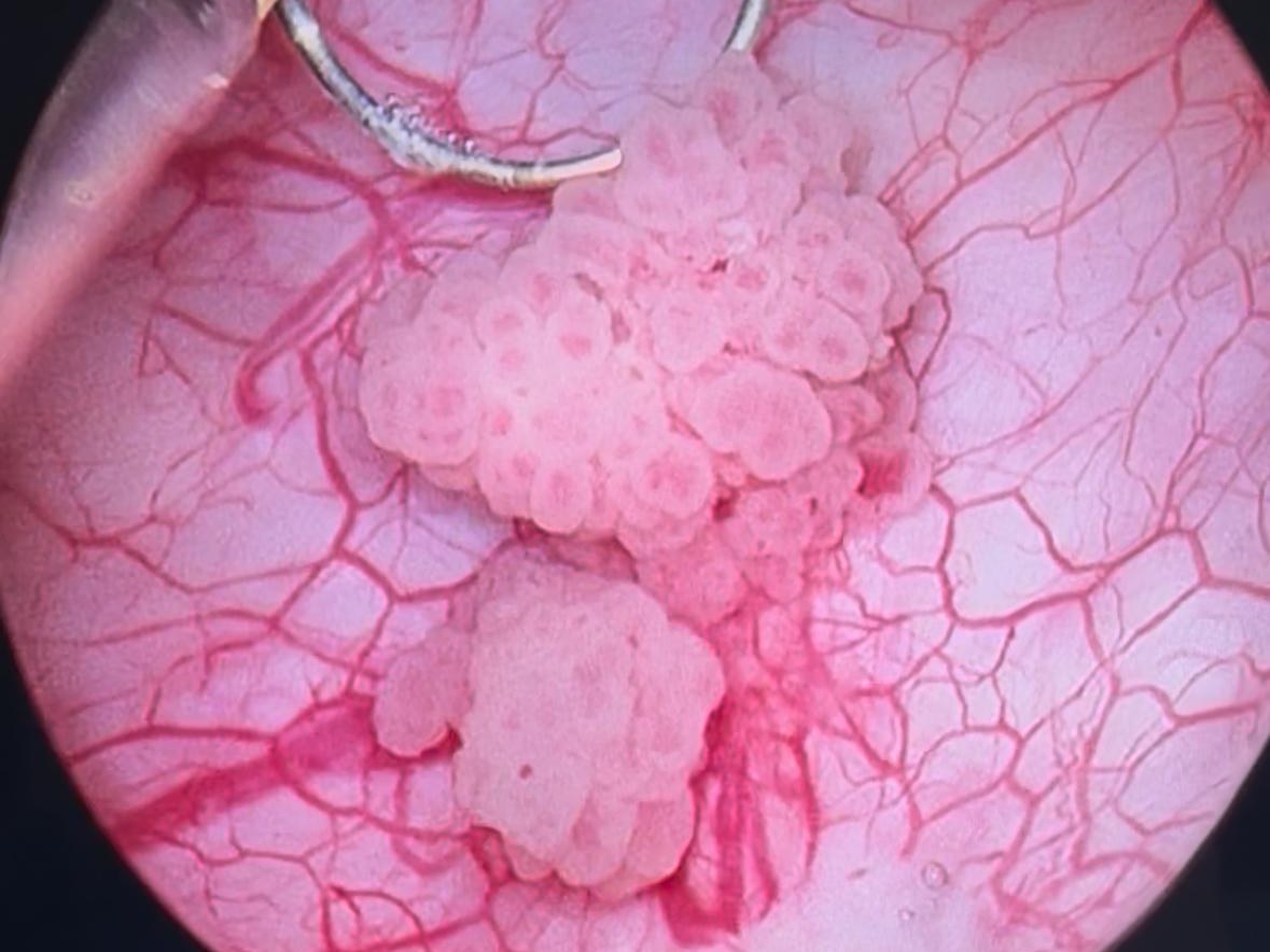 Endoscopic view of tissue being resected during a transurethral procedure